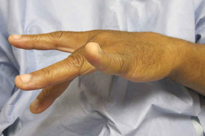 Posterior Interosseous Nerve Palsy Hand Surgery Resource